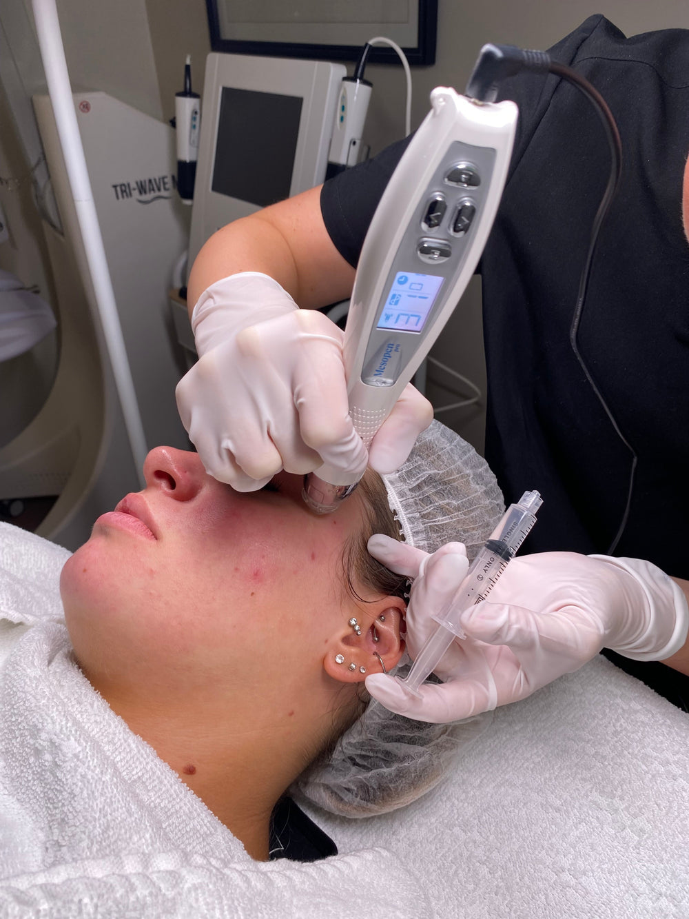 Mesopen Skin Needling